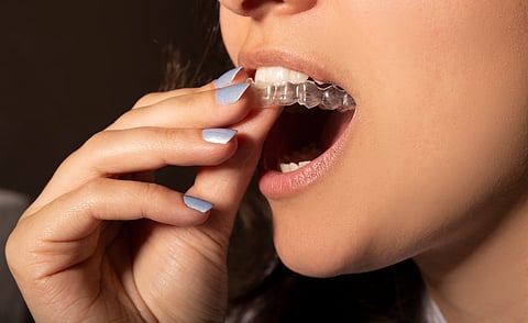 Woman wearing invisible braces or aligners