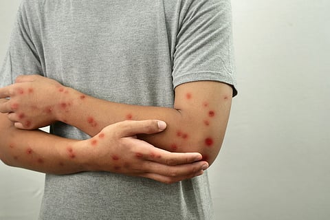 Kerala’s second Mpox case detected in a gulf returnee in Kochi