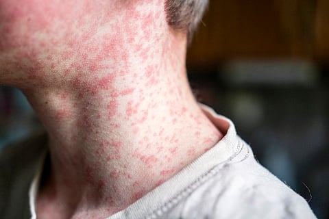 Measles can ravage the immune system and brain, causing long-term damage — a virologist explains