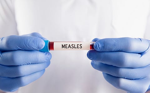 Virologists raise alarm over surge in measles cases worldwide