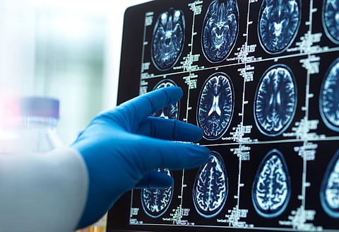 Alzheimer’s: Blood biomarker may help identify the disease ten years before symptoms start