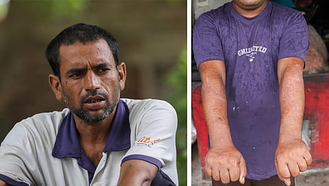 (From left) Rohit of Juriya village, Kanpur Dehat, developed skin rashes linked by doctors to contaminated water; (R) Govardhan of Khan Chandpur village developed skin lesions after contact with chromium-contaminated water.