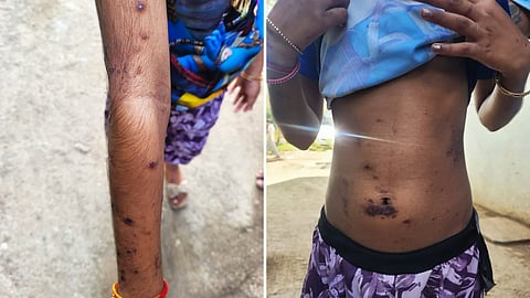 Children have developed blisters after bathing in polluted water (left) and show non-healing ulcers (right). Photographs taken on October 3, 2026.