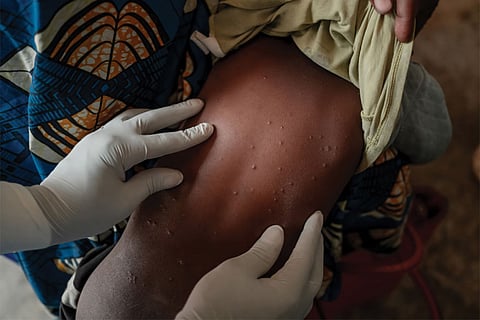 रिपोर्ट में कहा गया है कि टीकाकरण के प्रयास हाल ही में संक्रमित हुए लोगों के करीबी लोगों और स्वास्थ्य कर्मियों सहित सबसे अधिक खतरे वाले लोगों पर गौर करेंगे, ताकि बढ़ते संक्रमण को रोका जा सके।