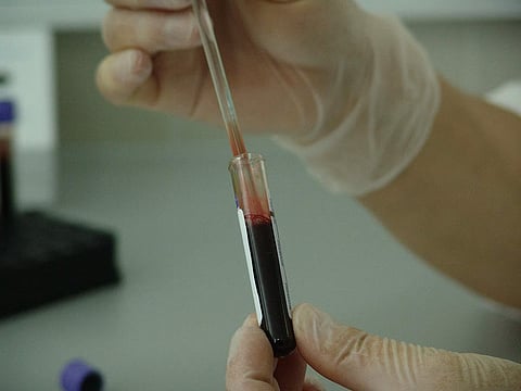 Researchers explore blood test for early pancreatic cancer detection