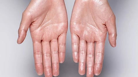 sweatning on hand