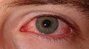 Mucormycosis