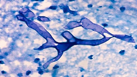 mucormycosis