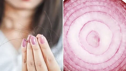 घरी बनवा  Onion Gel जे दूर करेल केसांचा पातळपणा