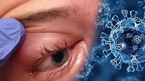  mucormycosis