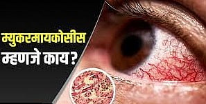 म्युकरमायकोसीस आजार कसा ओळखाल? गैरसमजच अधिक; घ्या योग्य उपचार