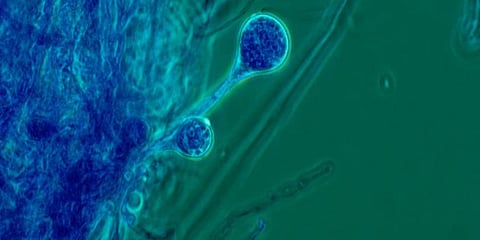 Mucormycosis