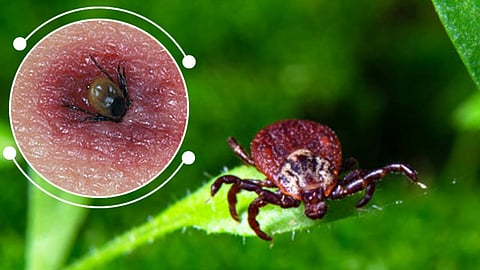 tick bite