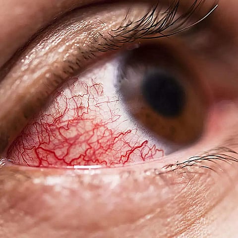 Mucormycosis