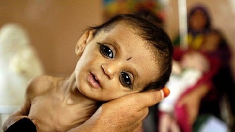 malnourished 