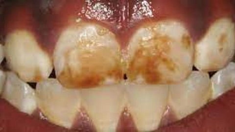 Dental fluorosis