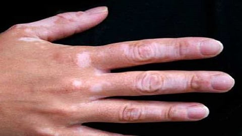 vitiligo