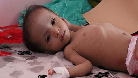 मेळघाटात वर्षभरात पाच बालकांच्या पोटावर चटके; तिघांचा मृत्यू