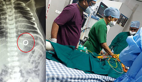 काही तासांपूर्वी जन्मलेल्या बाळानं गिळली सोन्याची अंगठी