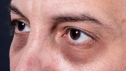 dark circles
