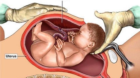
Cesarean section
