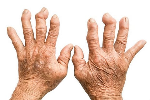 Rheumatoid arthritis - Symptoms and causes