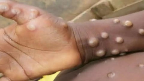 Monkeypox