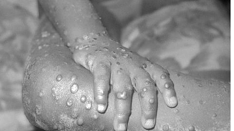 Monkeypox