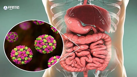 Norovirus