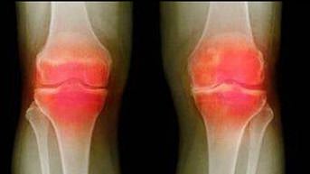 Arthritis