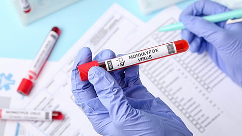 Monkeypox Outbreak 31 year old woman tests positive for monkeypox in delhi india tally rises to nine  