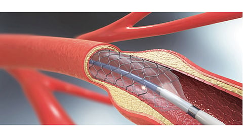 Angioplasty