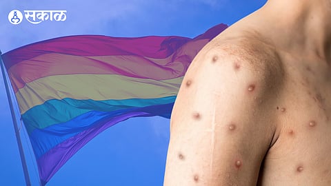  Monkeypox Virus