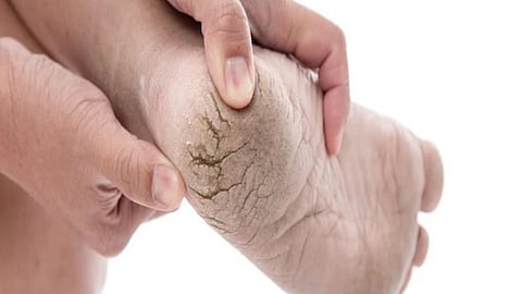 Cracked heels, use glycerin and honey to get soft and shiny feet
