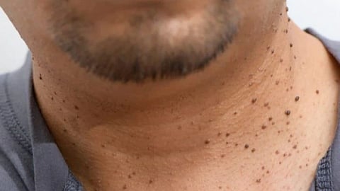 warts