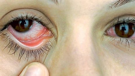eye disease