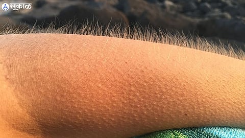 Goosebumps
