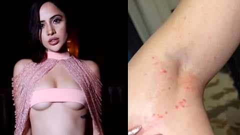 Urfi Javed birthday she shows bruises after her fashion urfi got injured