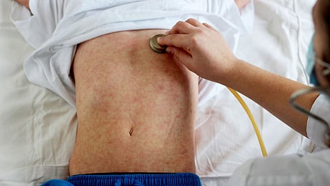 Measles Patient
