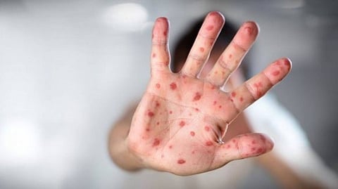 Measles Symptoms