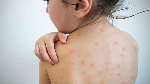 Measles Outbreak In Mumbai
