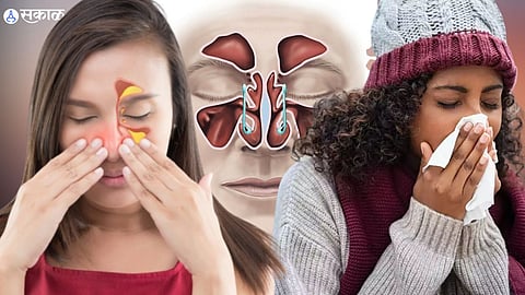 Sinus Symptoms