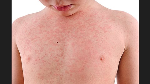 measles patients
