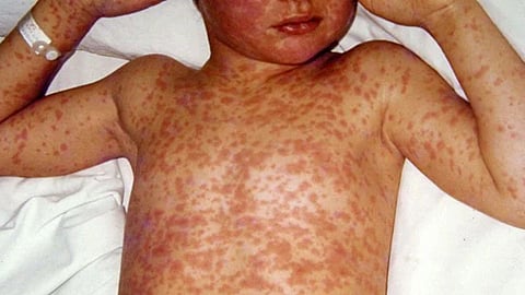 Measles Infection