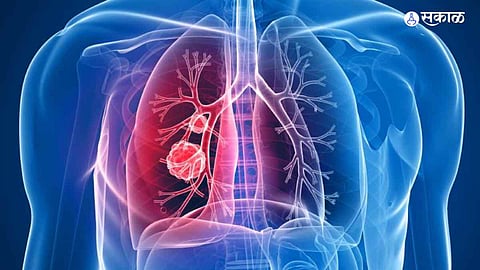 respiratory disorders due to air pollution Cement roads responsible dust particles
