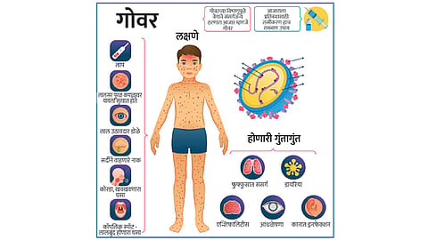 Measles