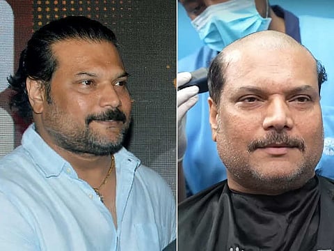 Hair Transplant