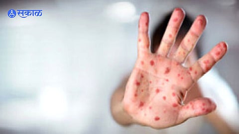 Measles Disease