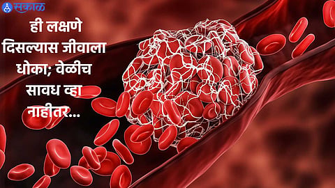 Blood Cloting Signs