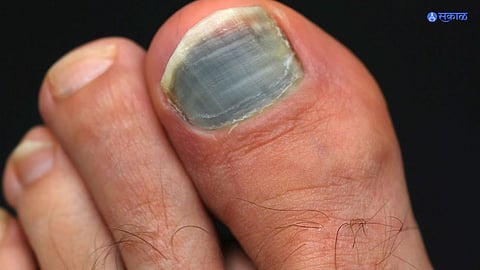 Black Toe Nail